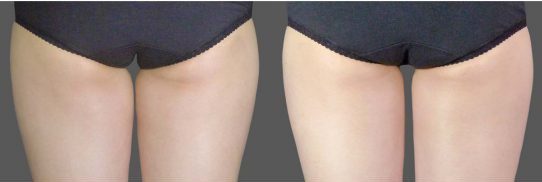 coolsculpting inner thighs before and after