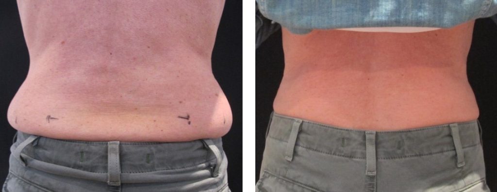 coolsculpting love handles before and after