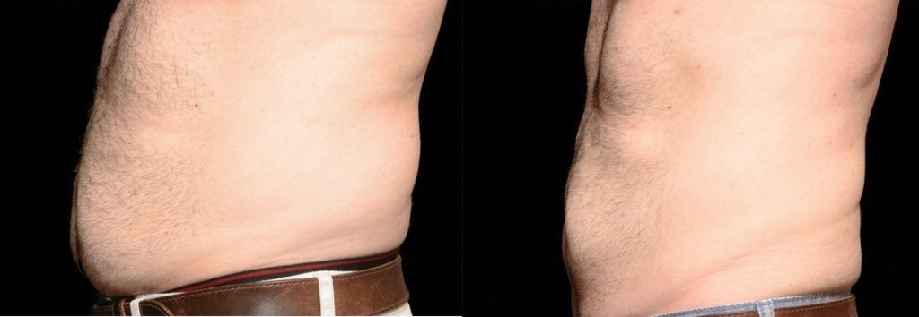 coolsculpting men before and after belly fat
