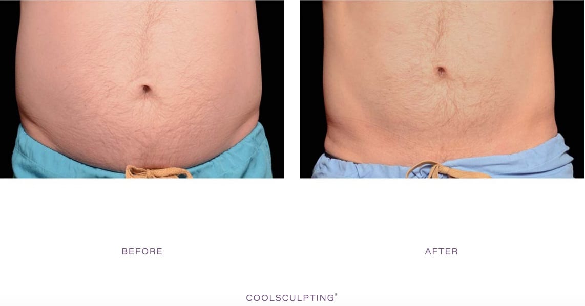 Belly Fat Freezing with CoolSculpting, CoolSculpting Stomach