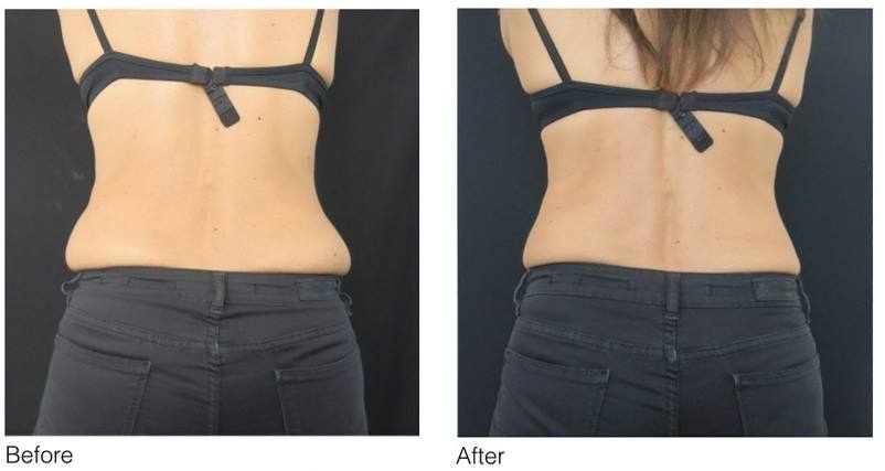 CoolSculpting Results Before and After