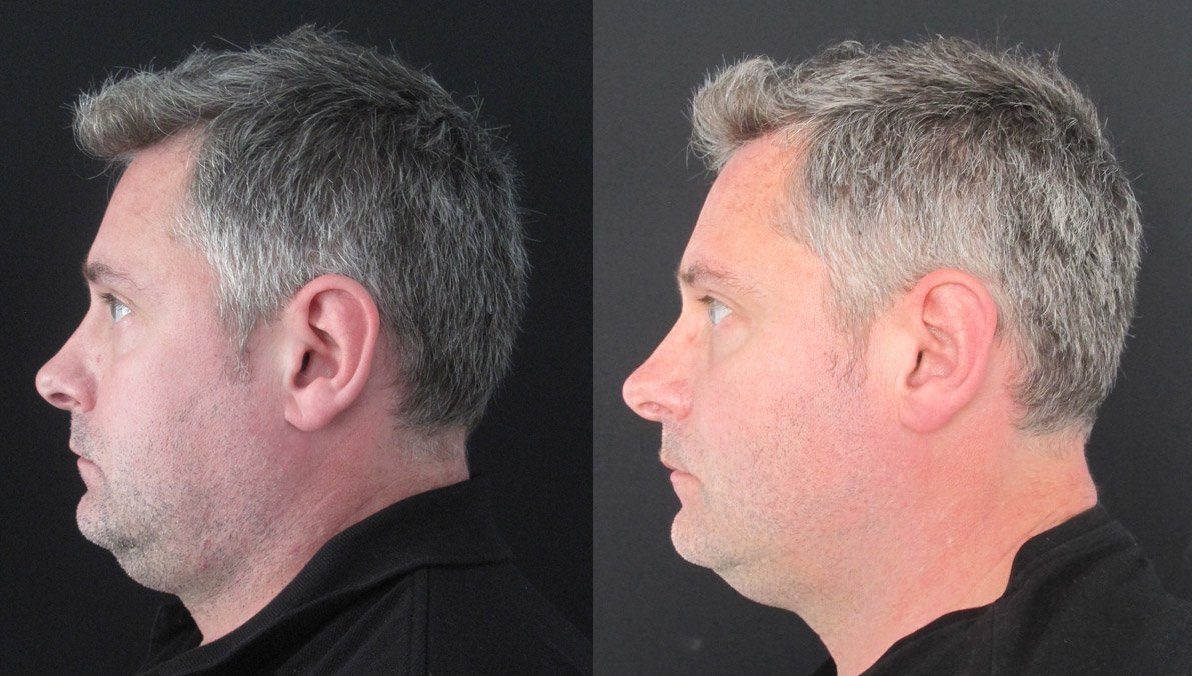 coolsculpting under chin fat before and after