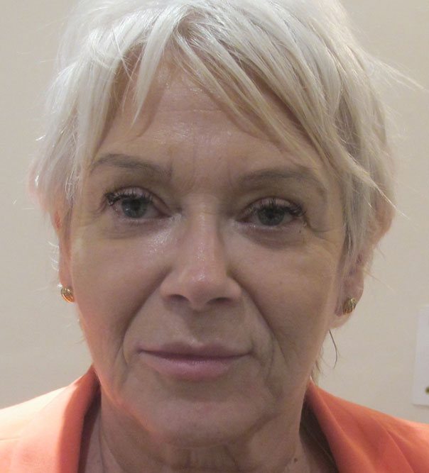 A lady after having a full face rejuvenation