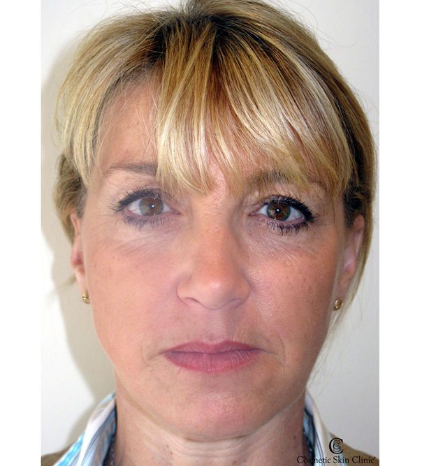 A lady after a full face rejuvenation using Juvederm and MD Codes
