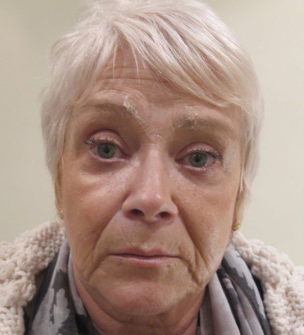 A lady before a full face rejuvenation and chin fillers