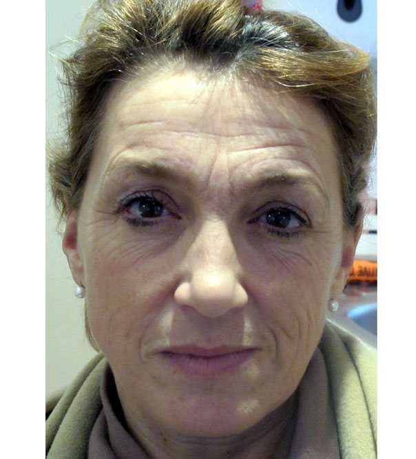A before image of a lady prior to a full face rejuvenation