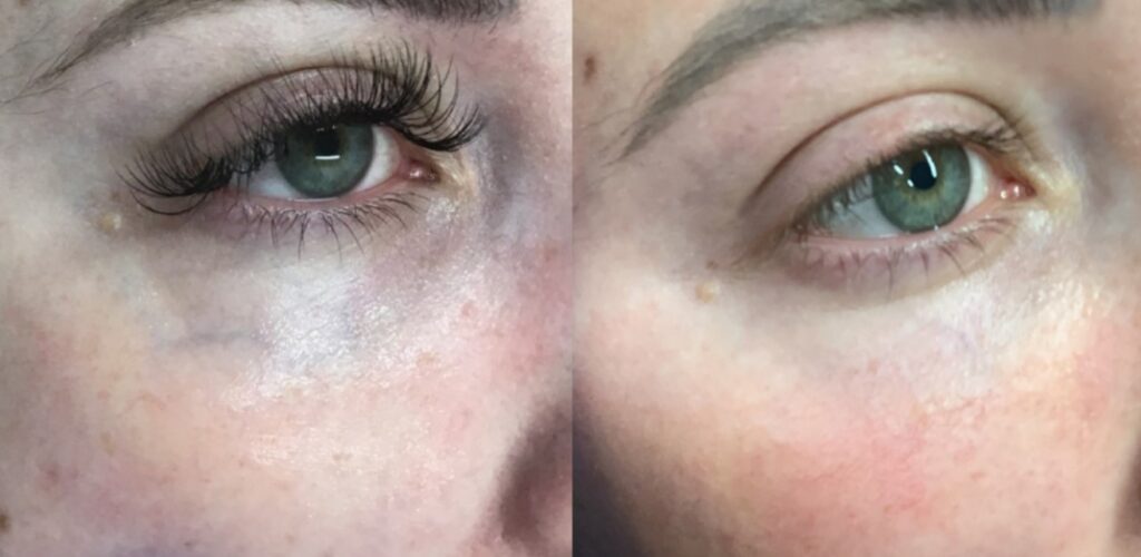 Eye rejuvenation
