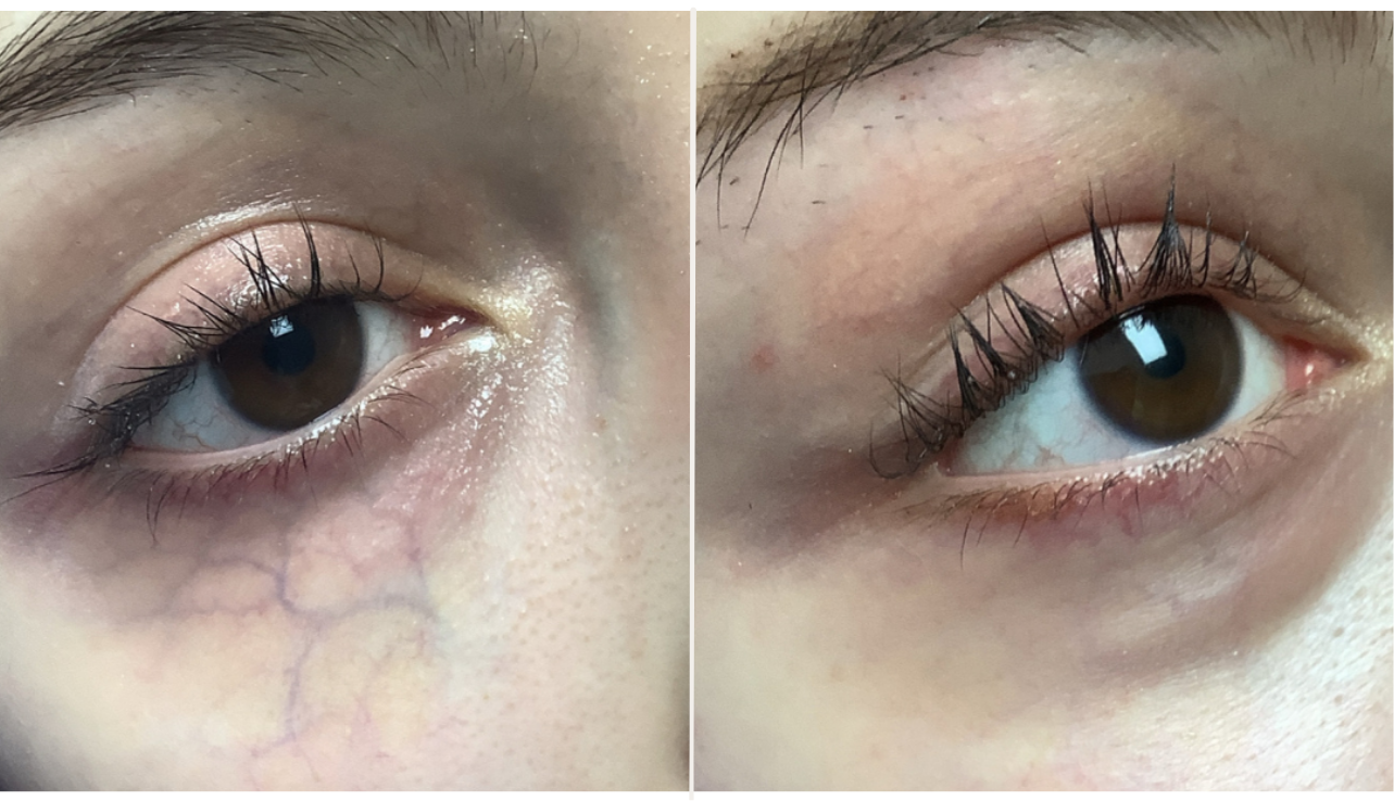 cutera coolglide under eye veins