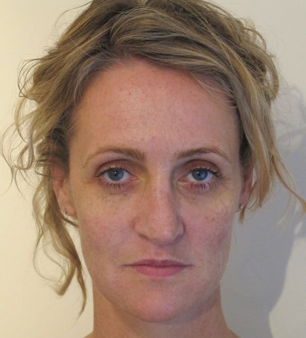 Non-surgical Facelift in London