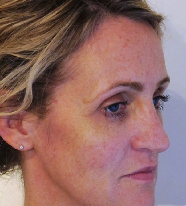 Non-surgical Facelift in Buckinghamshire