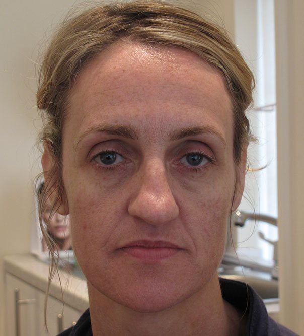 A lady before having full face rejuvenation with Juvederm
