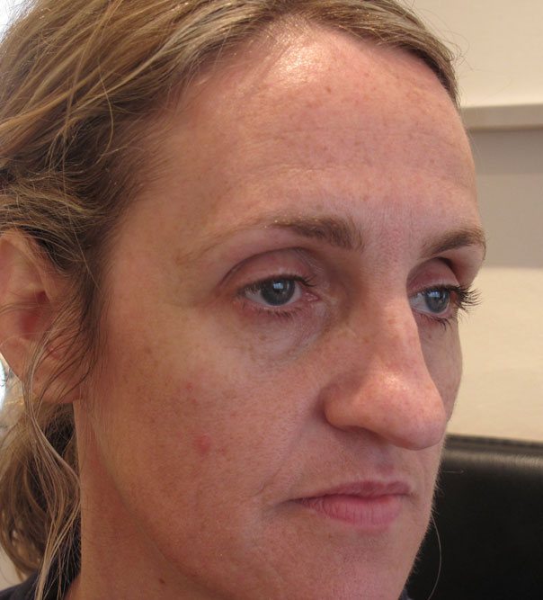 A lady before a full face rejuvenation