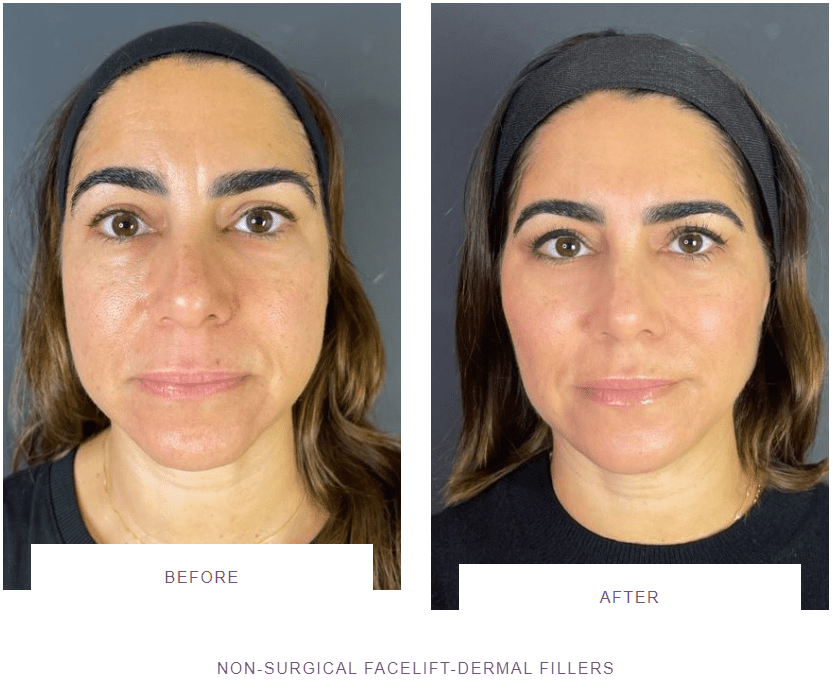 non surgical facelift with dermal fillers