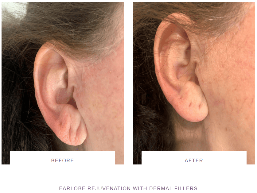 earlobe rejuvenation with dermal fillers