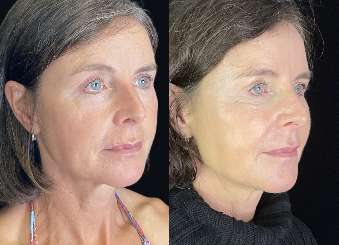 dermal filler before and after, facial filler, cheek filler before after