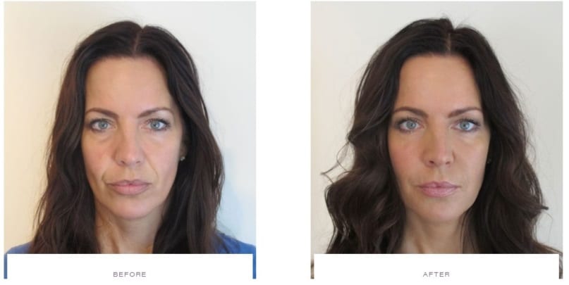 facelift with dermal fillers before and after results