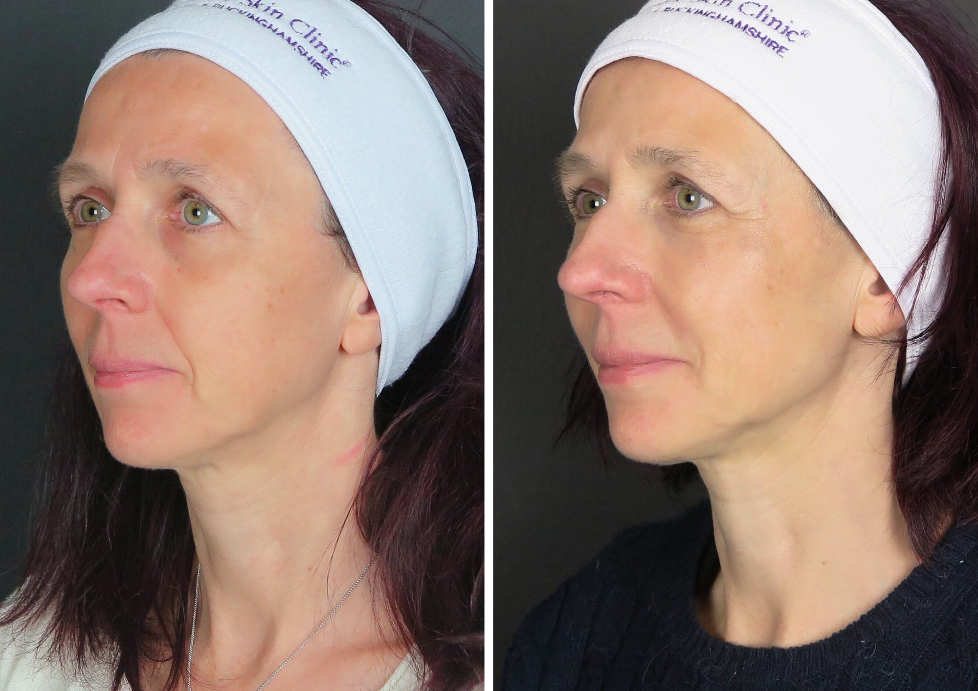 dermal filler tear troughs, temples, nasolabial folds, cheeks, jawline before and after results
