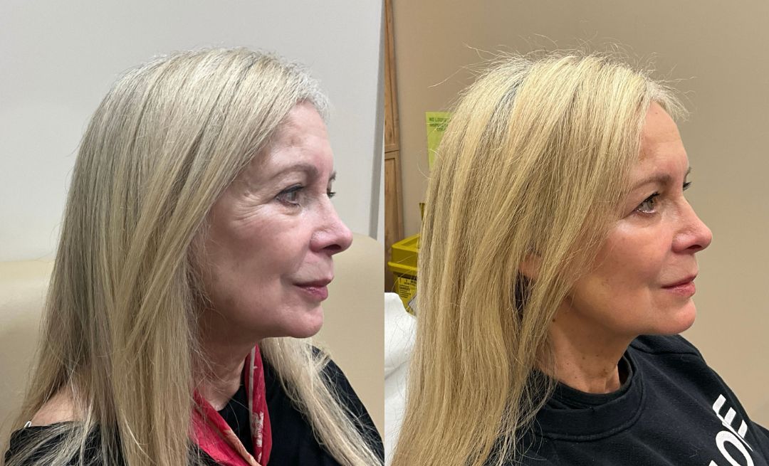 Before and after dermal filler and anti-wrinkle injections to temples, chin, jawline and marionette lines by Dr Matthew Jarvie-Thomas.