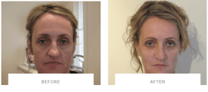 dermal fillers facelift before after