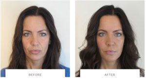 dermal fillers facial rejuvenation before after