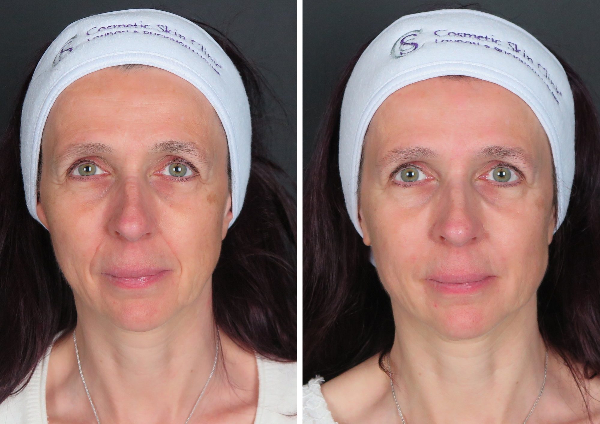 dermal fillers for nasolabial folds nose to mouth lines before and after