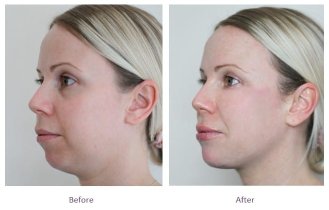 dermal fillers full face rejuvenation before after