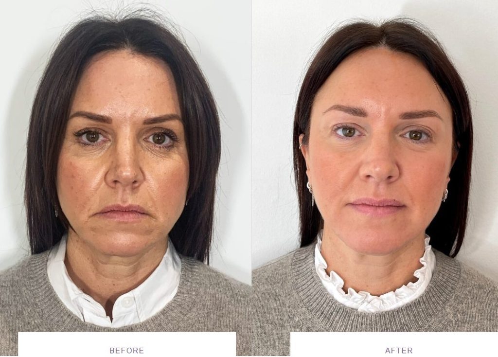 dermal fillers full face rejuvenation before and after results, under eye filler