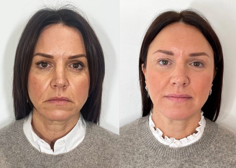 mid face lift with fillers before and after