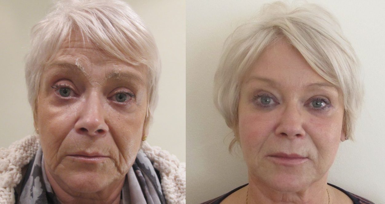 dermal fillers nose to mouth lines lip filler rejuvenation before and after