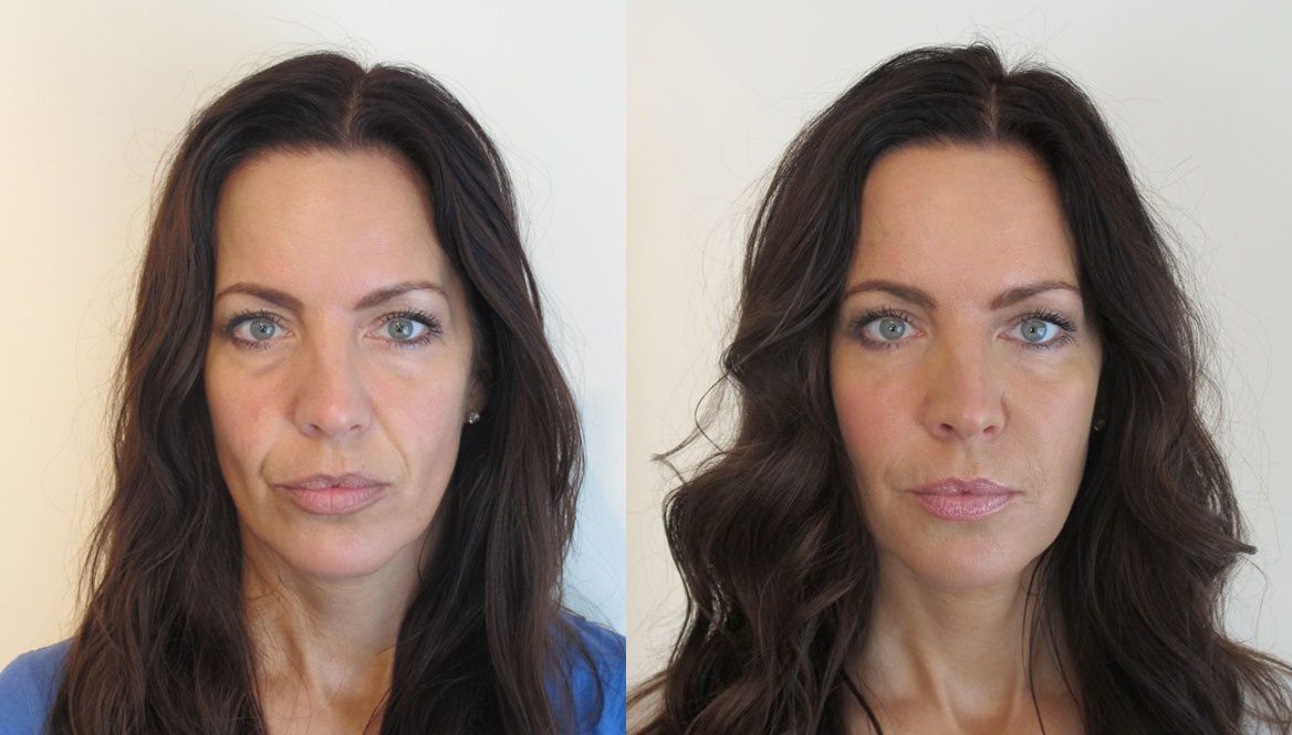 dermal filler nose to mouth lines, cheek hollows, tear troughs before and after