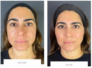 dermal fillers skin tightening before after