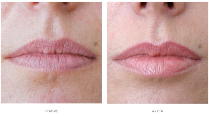 Dermal Fillers Smokers Lines Before and After, smokers lines before and after