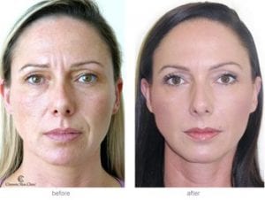 Before and after face fillers photo
