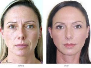 Facial rejuvenation with dermal fillers Before and after face fillers photo