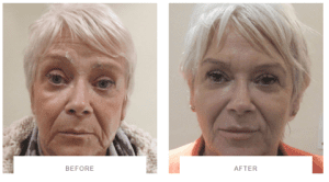 dermal fillers wrinkles treatment before after