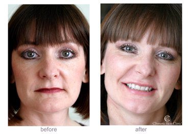 Restylane Dermal Fillers - Non-Surgical Face Lift