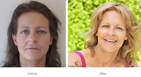 Juvederm is a semi long lasting long lasting dermal filler Juvederm is a semi long lasting long lasting dermal filler