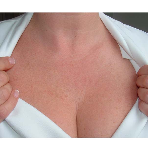 Tightened skin on the chest after treatment with Genuine Dermaroller
