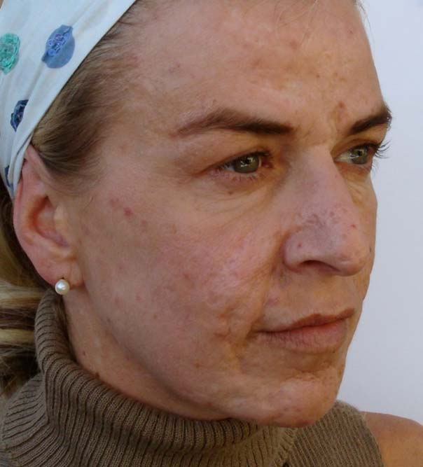A lady with reduced facial scarring following Dermaroller treatment