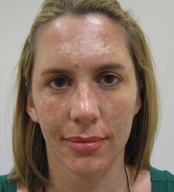The face of a lady before Dermaroller treatment