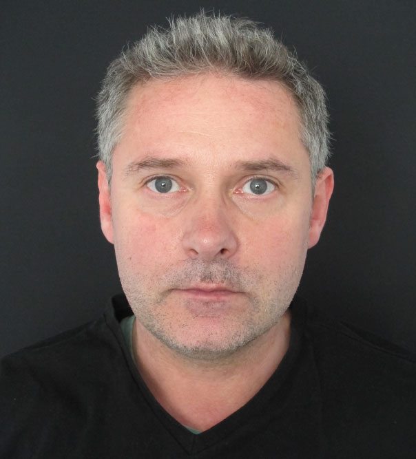 Man after having fat-freezing treatment for a double chin