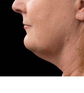 Double Chin CoolSculpting After Coolsculpting After Chin