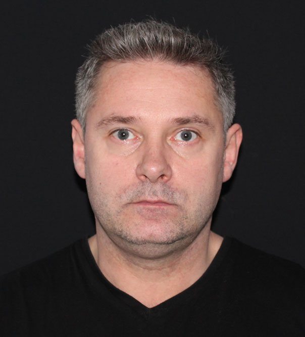 A man with a double chin before treatment