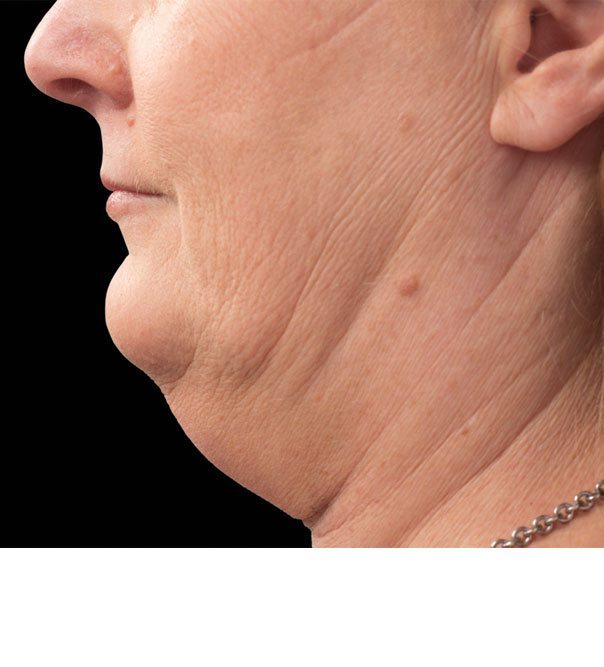 Coolsculpting Before Chin