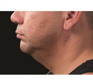 double chin fat removal CoolSulpting after