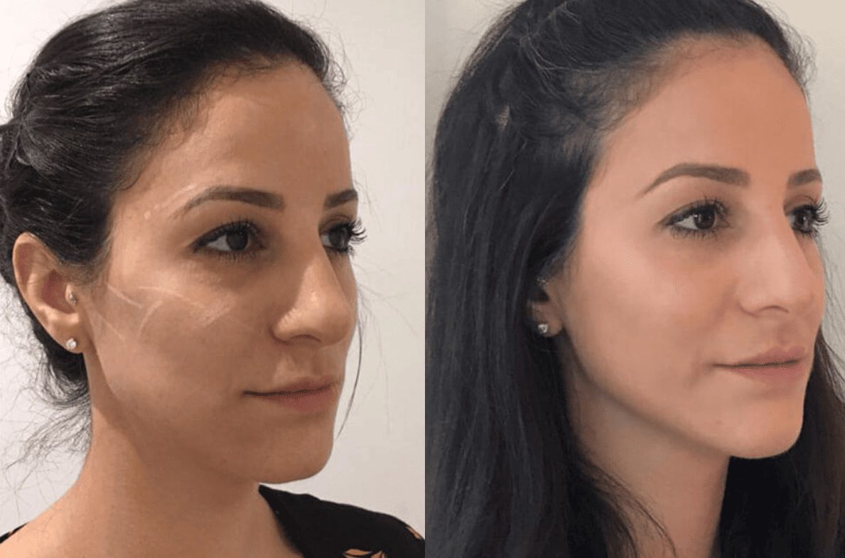 cheekbones and under eye ellanse dermal filler before and after results