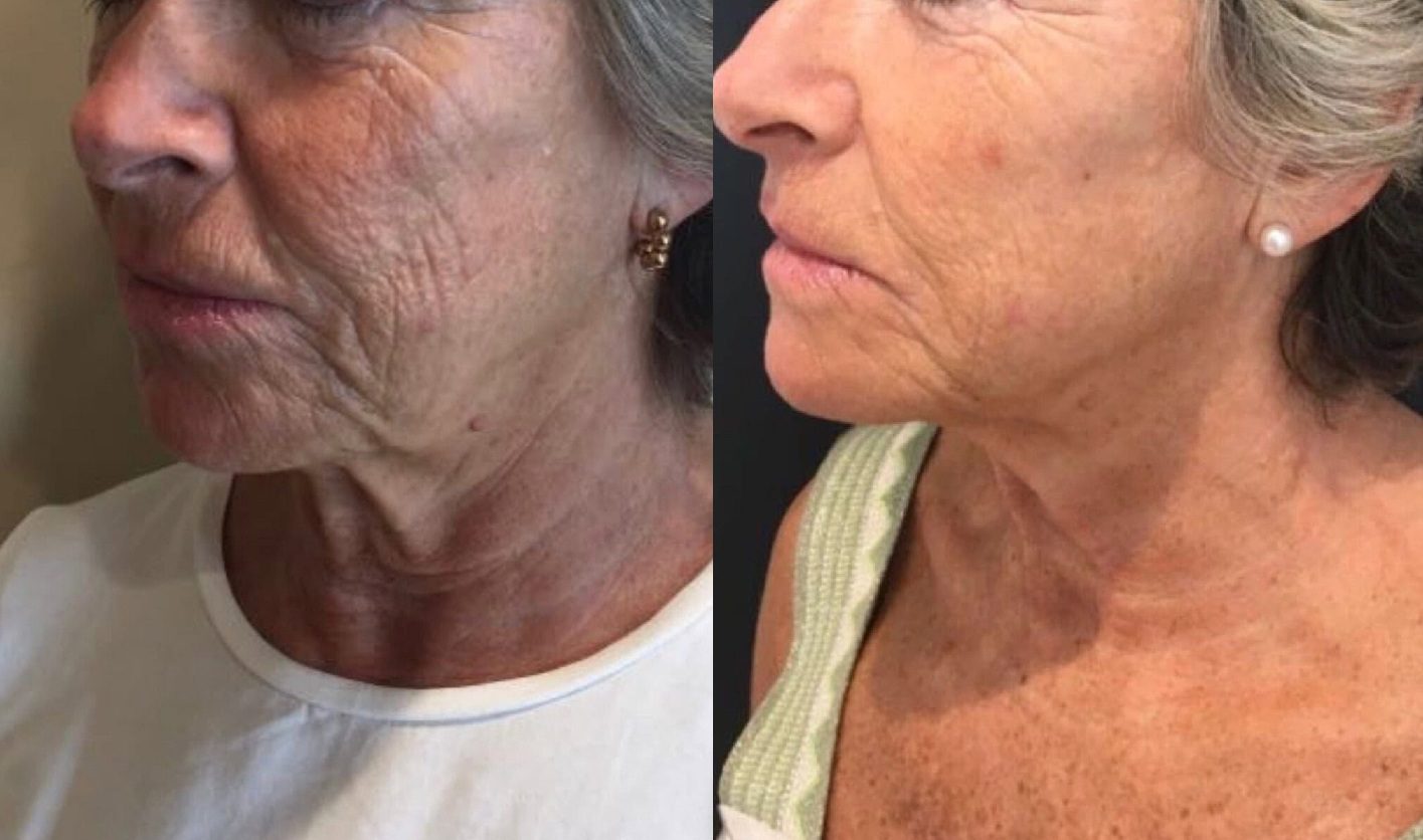 Ellanse dermal fillers treatment, jawline, cheeks results before and after
