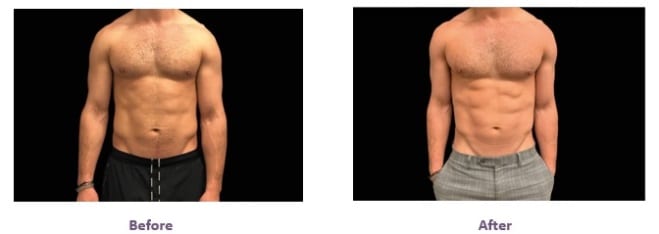 EmSculpt abs before and after emsculpt before after results