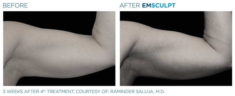 EMSculpt Arms Before and After
