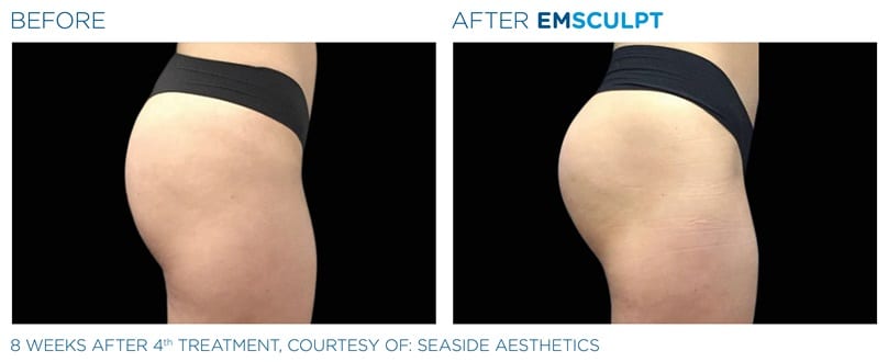 EMSculpt Before and After Buttocks